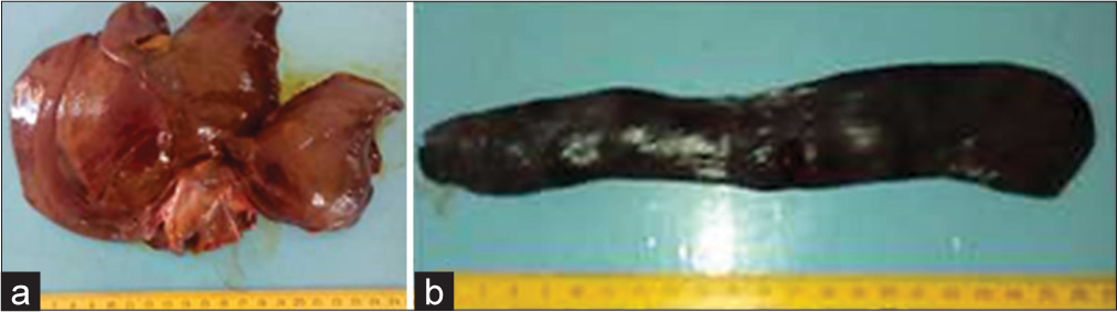 (a) Enlarged and congested liver, (b) enlarged spleen.