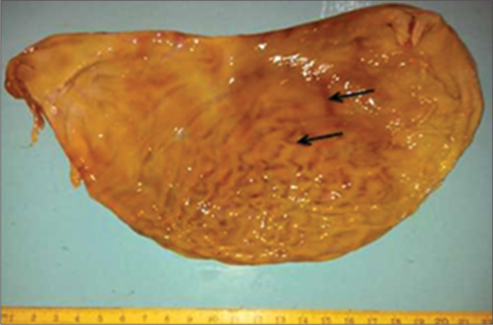 Hemorrhages in the gastric mucosa (black arrows).