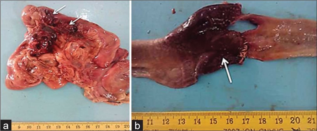 (a) Intestinal hemorrhages (arrows), (b) an area of hemorrhagic infarct at the intestinal anastomosed site (arrow).