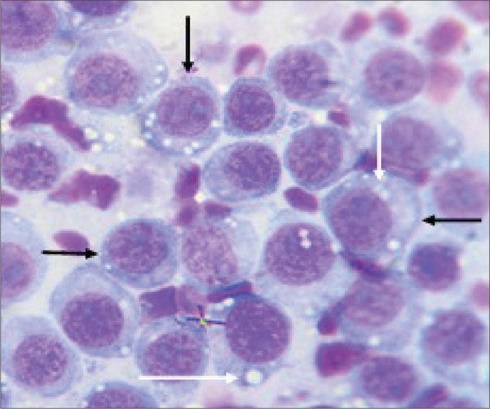 Cytomorphology of canine transmissible venereal tumor in 2-year-old Neapolitan Mastiff dog. Showing; characteristic round cells having large eccentric nuclei (black arrows) and intracytoplasmic vacuolations (white arrows). Anisocytosis and anisokaryosis and a large nuclear-cytoplasmic ratio were noted. mag. ×1000.