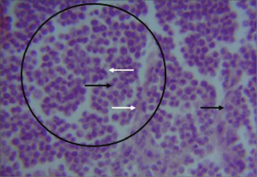 Photomicrograph of canine transmissible venereal tumor in 2-year-old Neapolitan Mastiff dog. Shows; sheets of round neoplastic cells with prominent nuclei (black circled area) few mitotic figures (black arrow), surrounding collagen deposits (white arrows), and infiltrating lymphocytes. H&E Stain ×400.