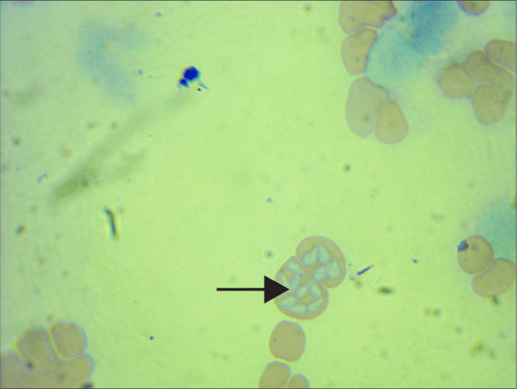 Photomicrograph of the infected patient. The black arrow shows red blood cells infected with pear-shaped Babesia spp.