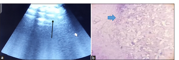 (a) Ultrasonography of the ventral abdominal region of the patient showing hyperechoic nodular subcutaneous masses (black arrow). (b) Photomicrograph of the aspiration biopsy smear showing necrosis of the subcutaneous adipocytes (Giemsa ×100)